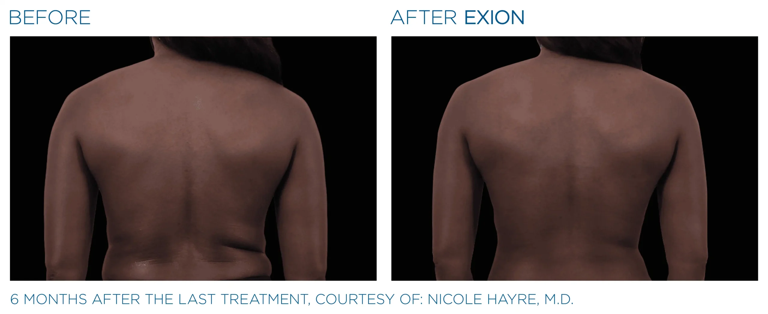 Exion Before & After 11