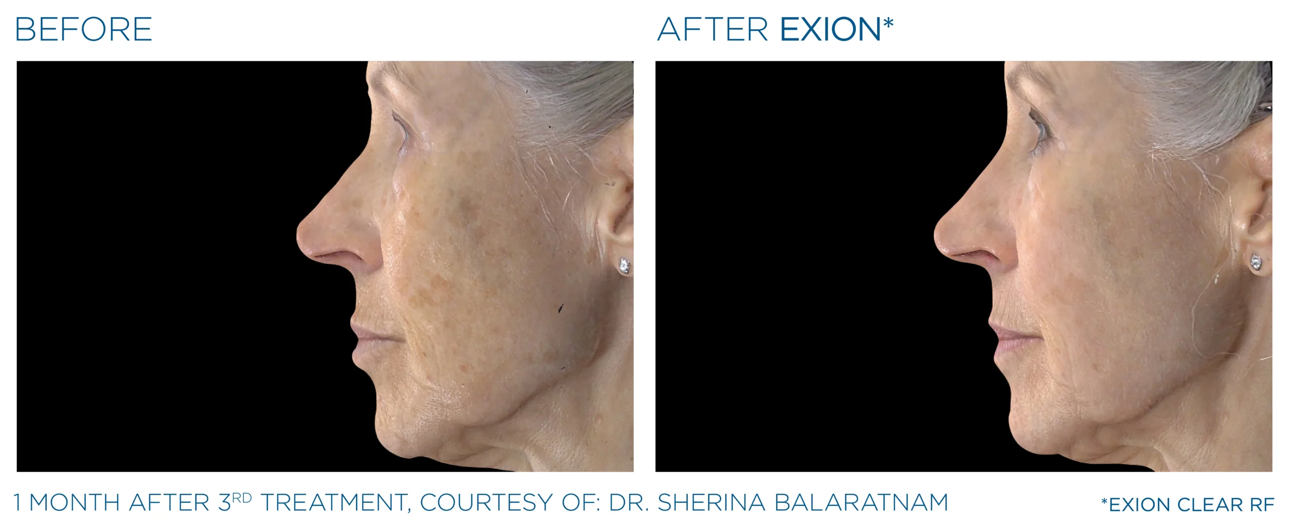 Exion Before & After 12