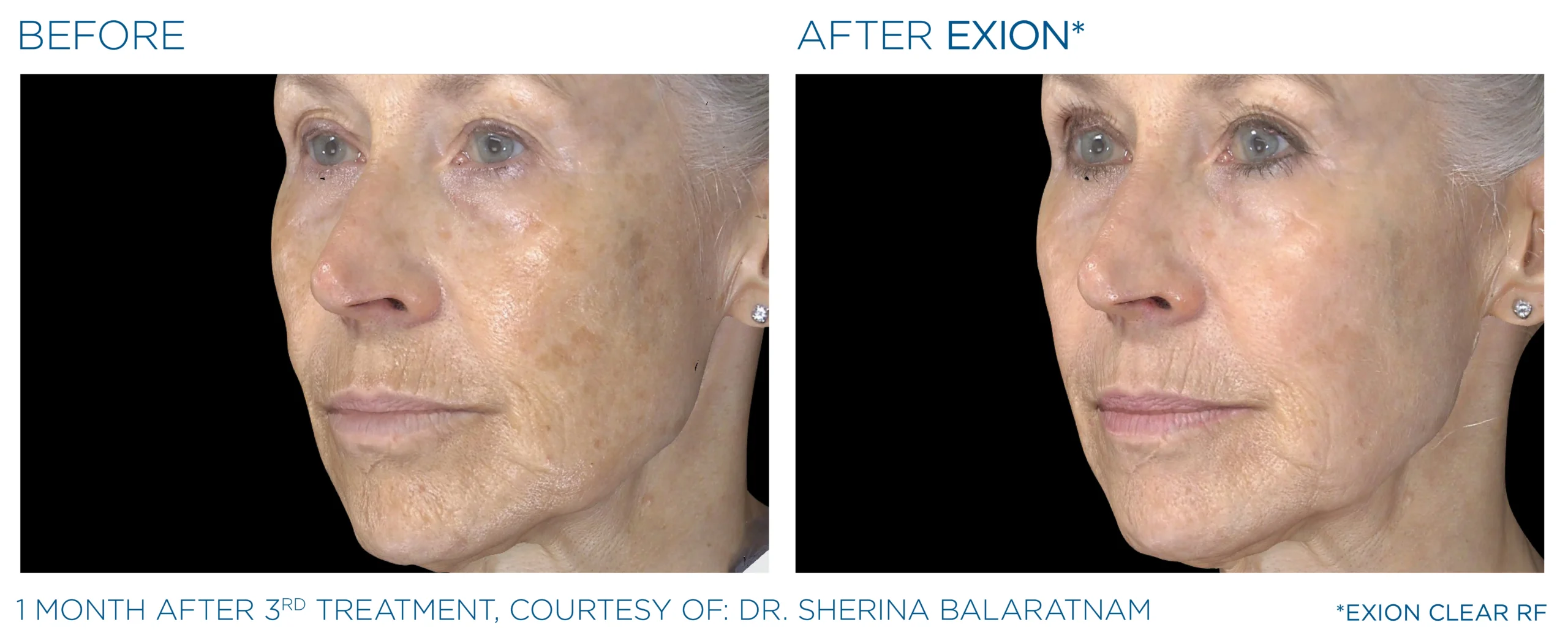 Exion Before & After 13
