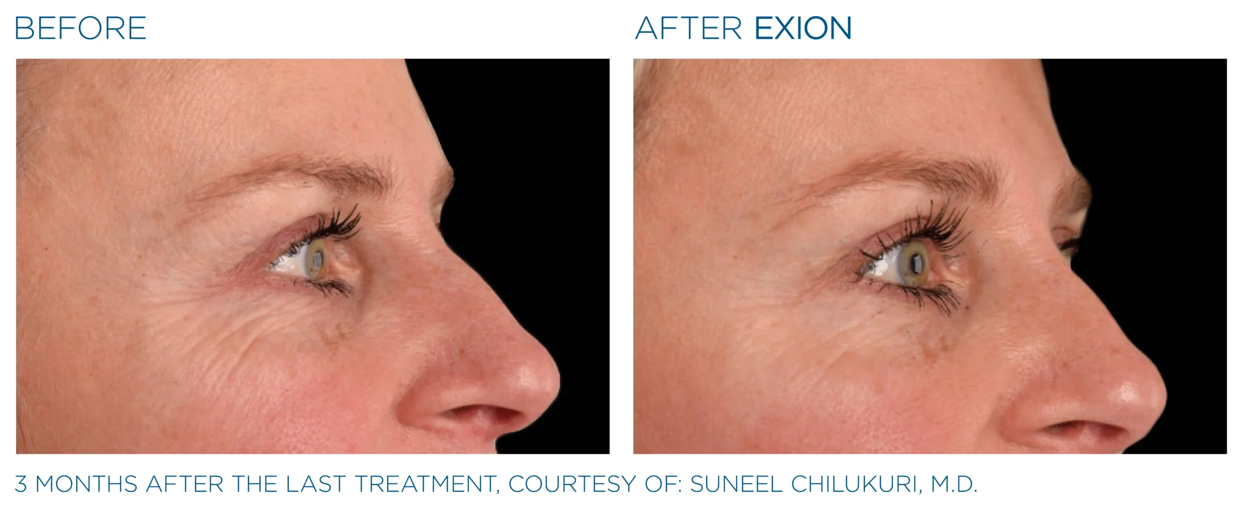 Exion Before & After 14