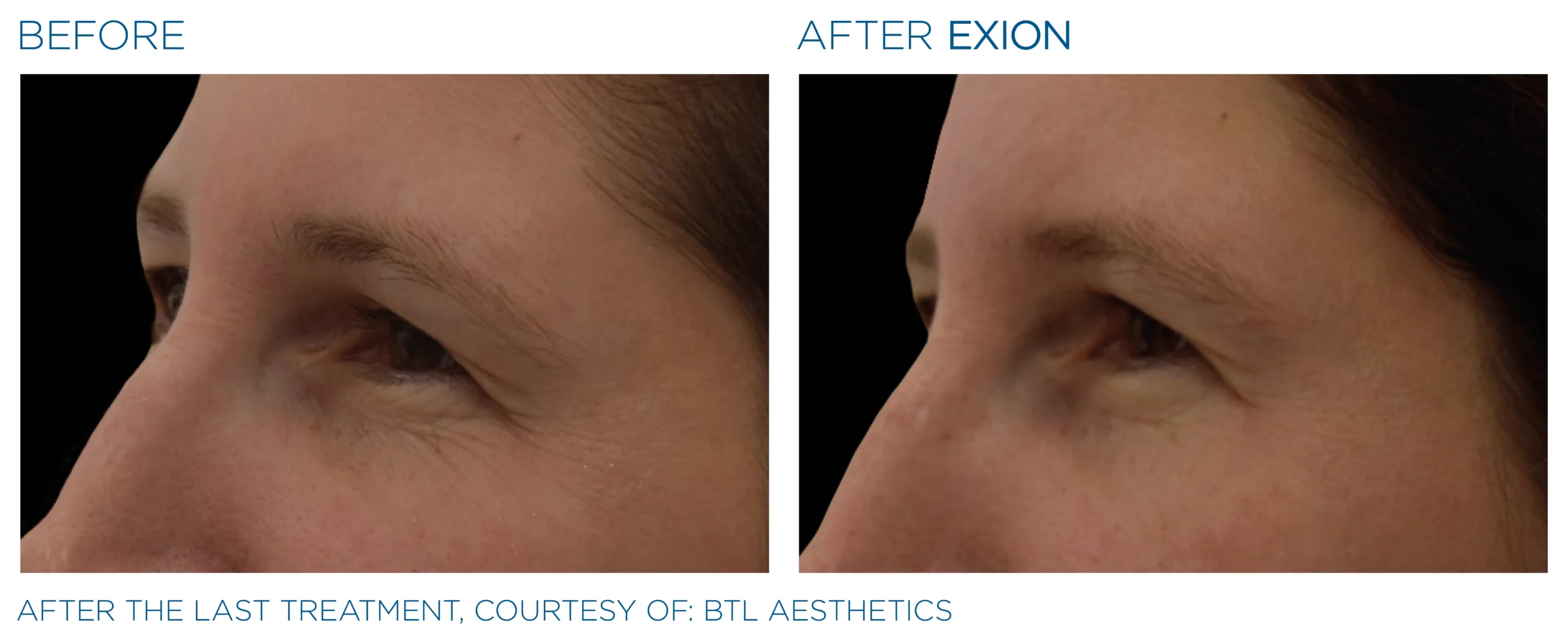 Exion Before & After 15