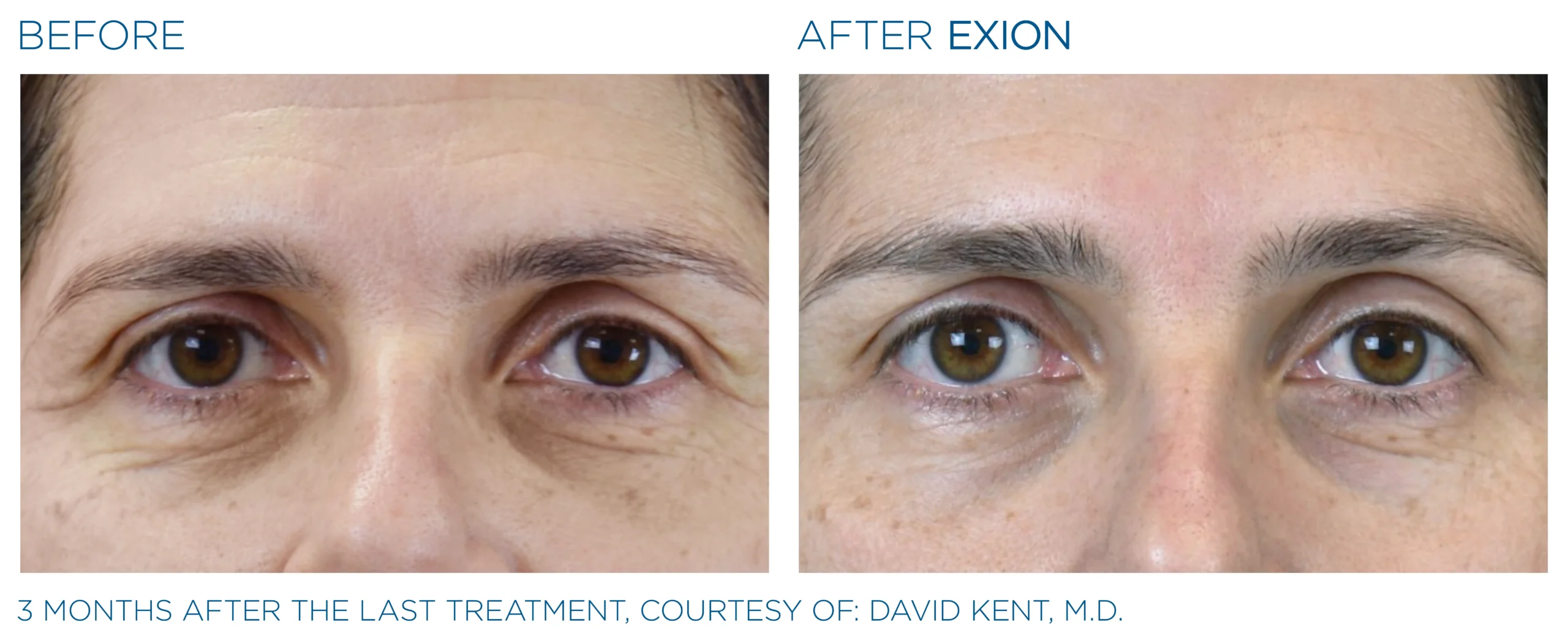 Exion Before & After 16