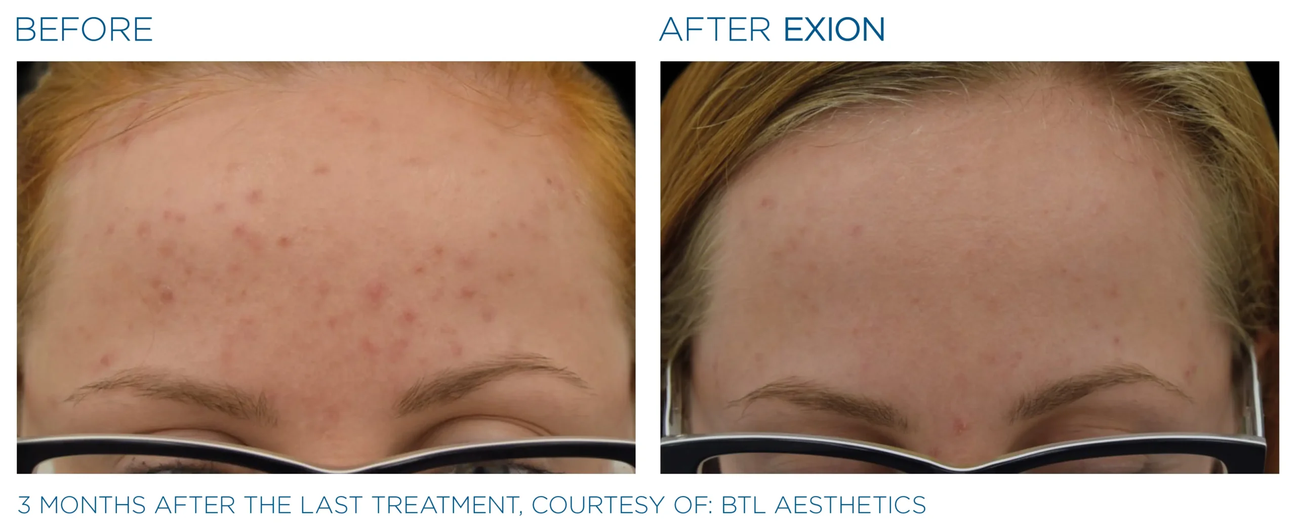 Exion Before & After 18