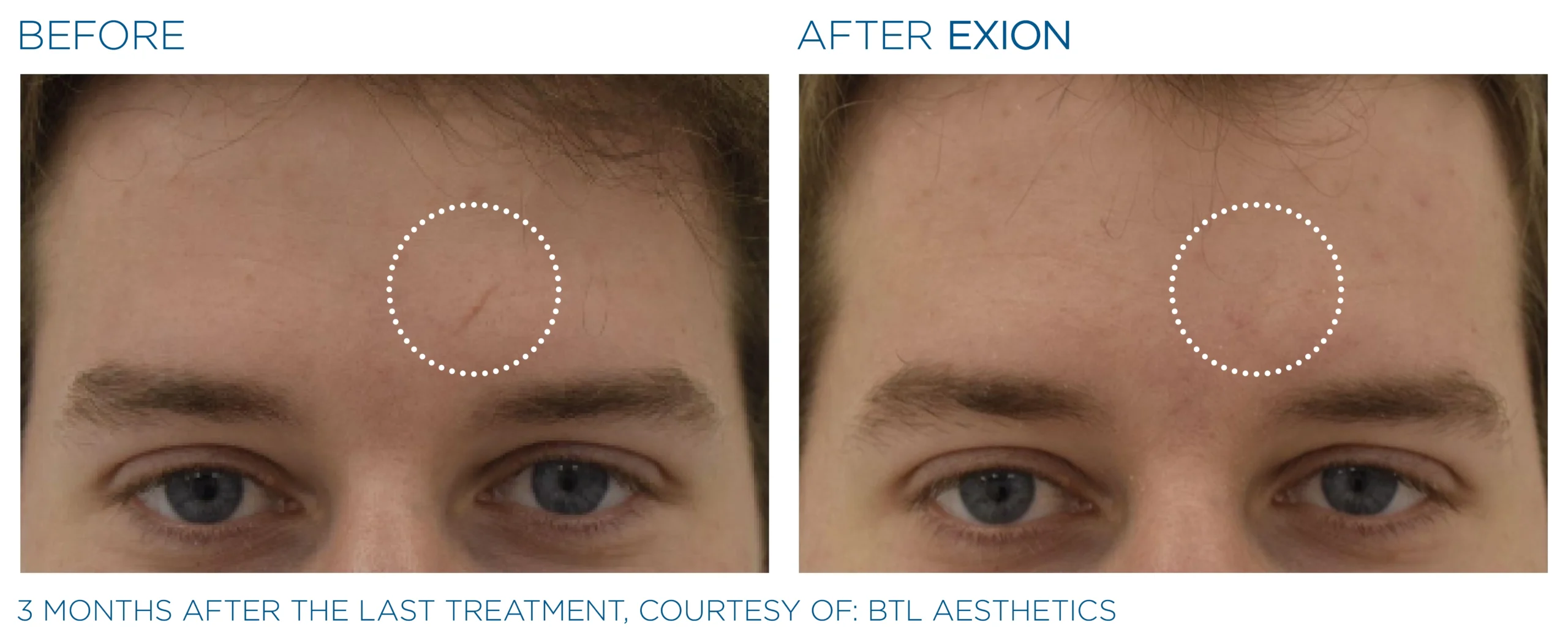 Exion Before & After 19