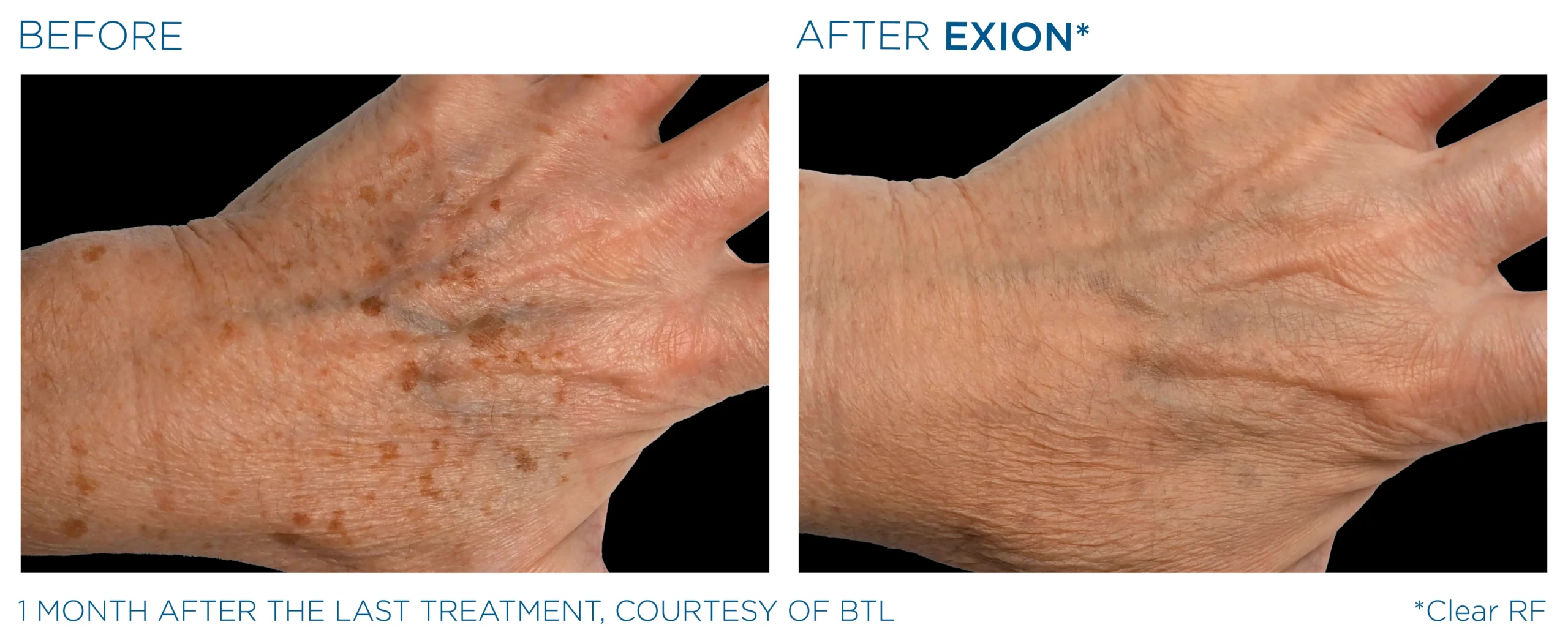 Exion Before & After 20