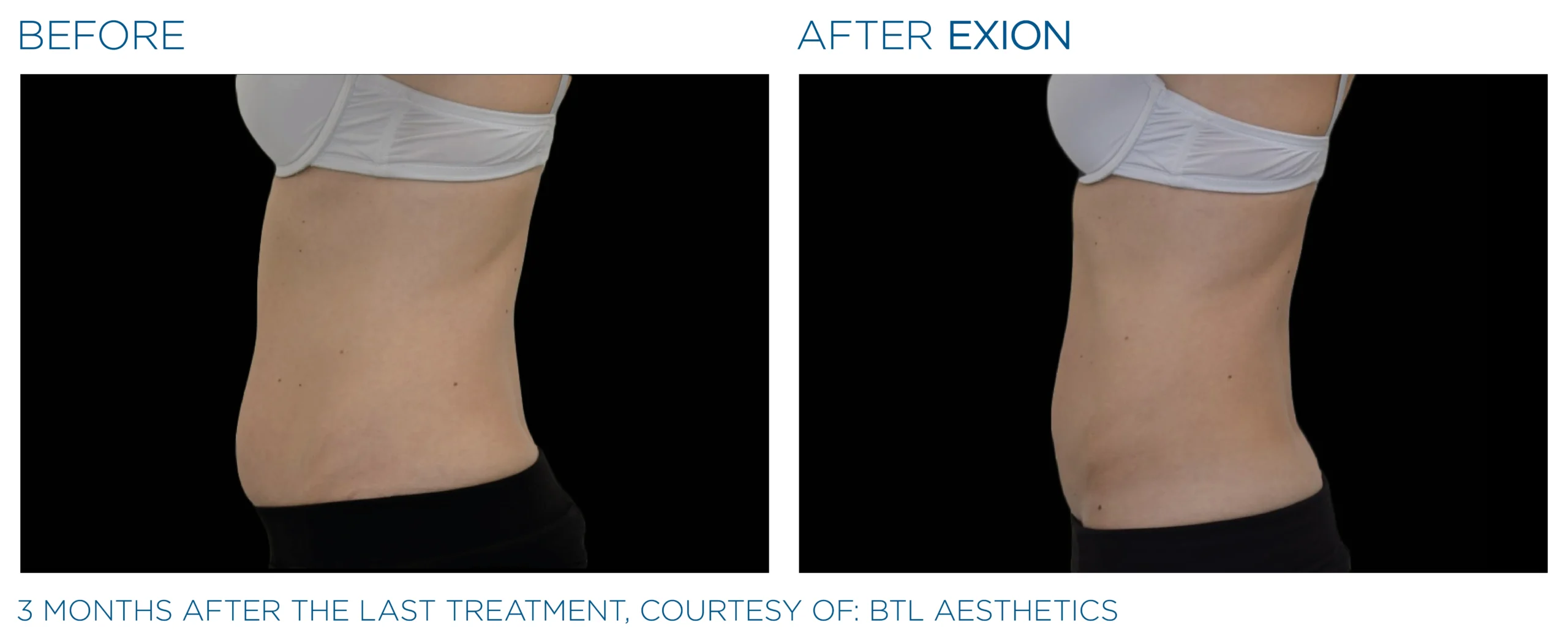 Exion Before & After 21