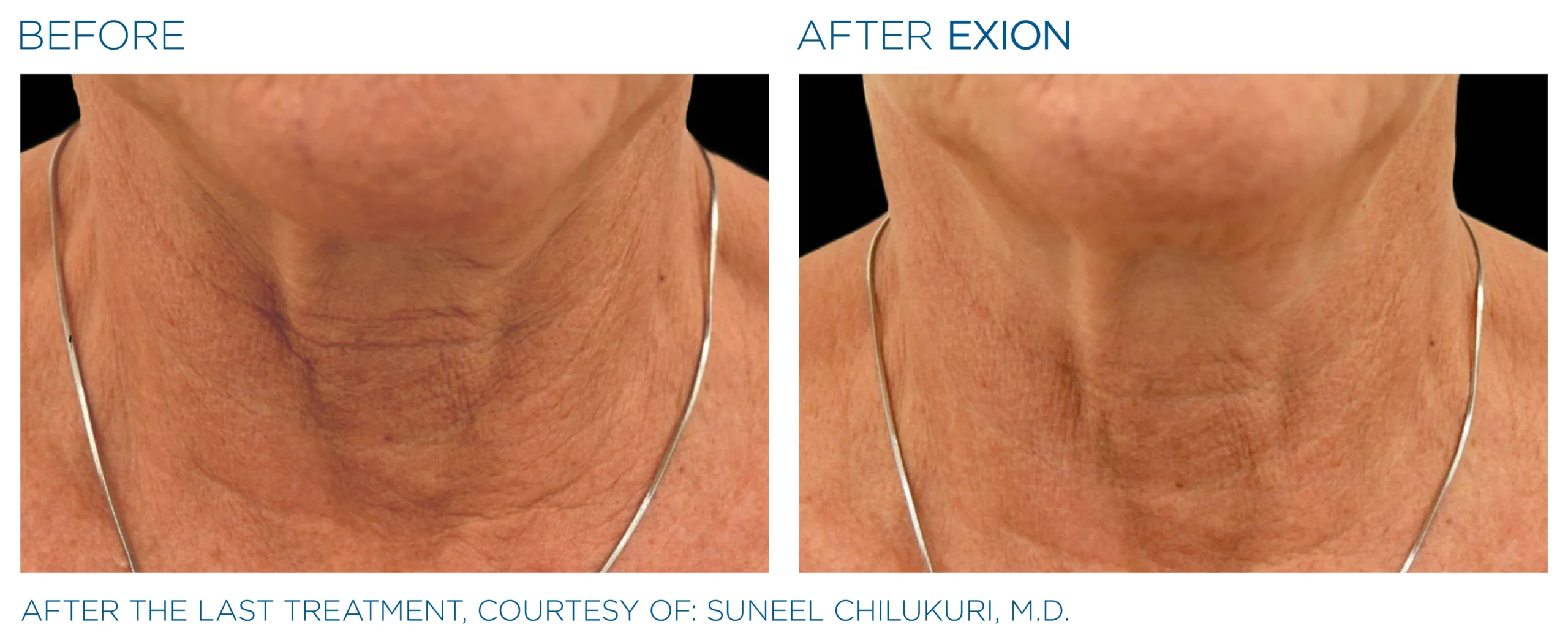 Exion Before & After 23