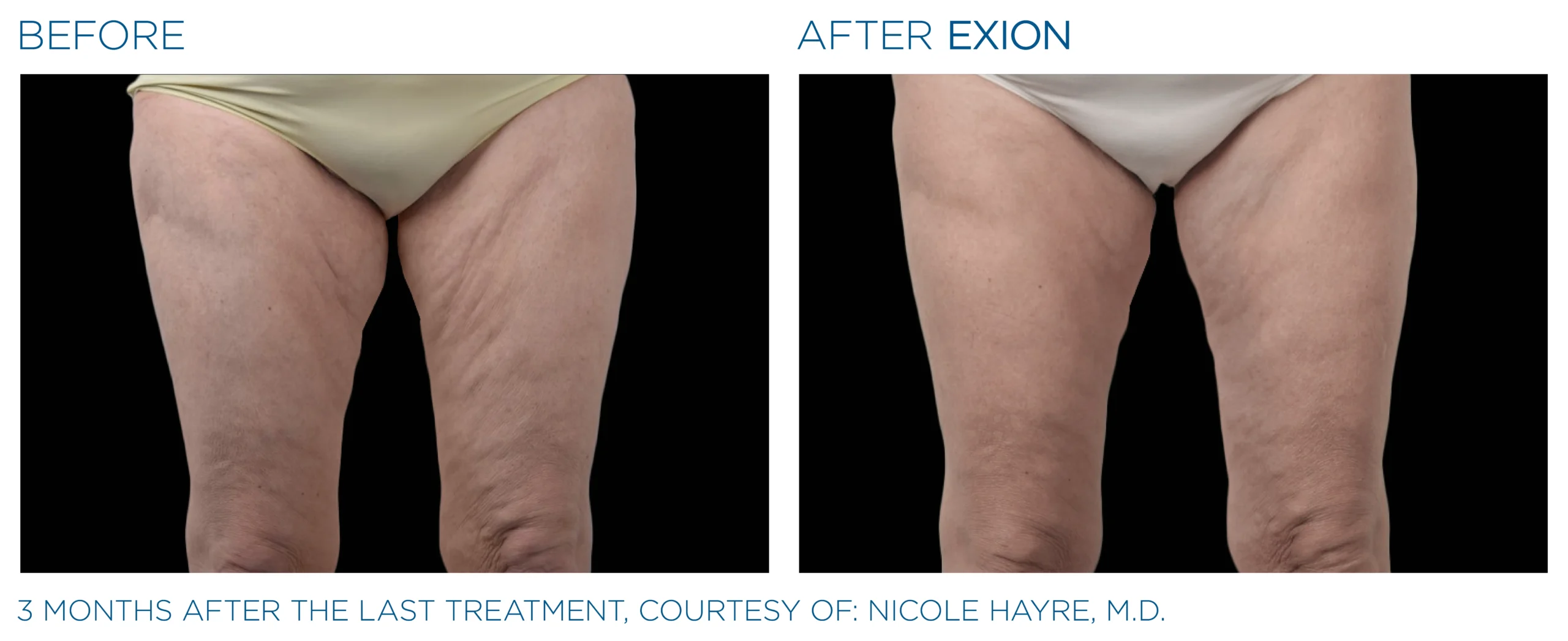 Exion Before & After 24