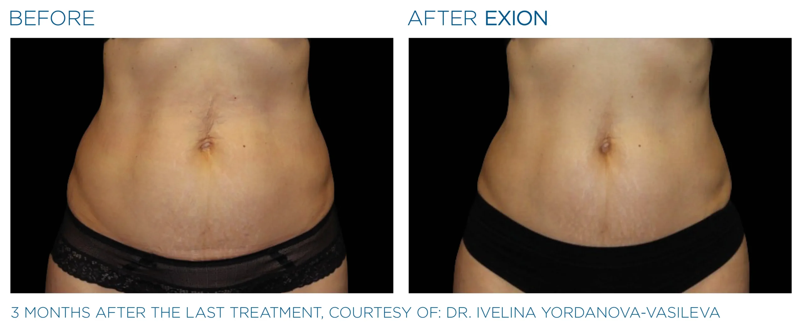 Exion Before & After 5