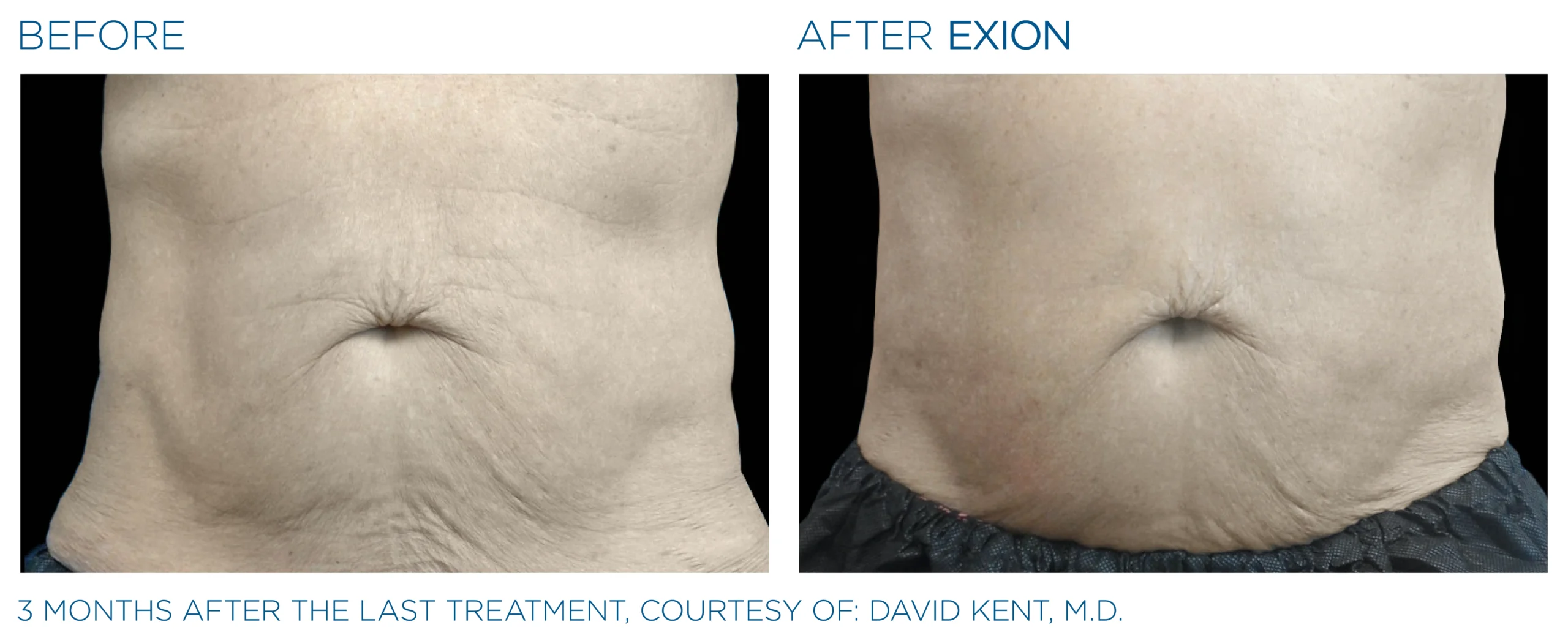 Exion Before & After 6