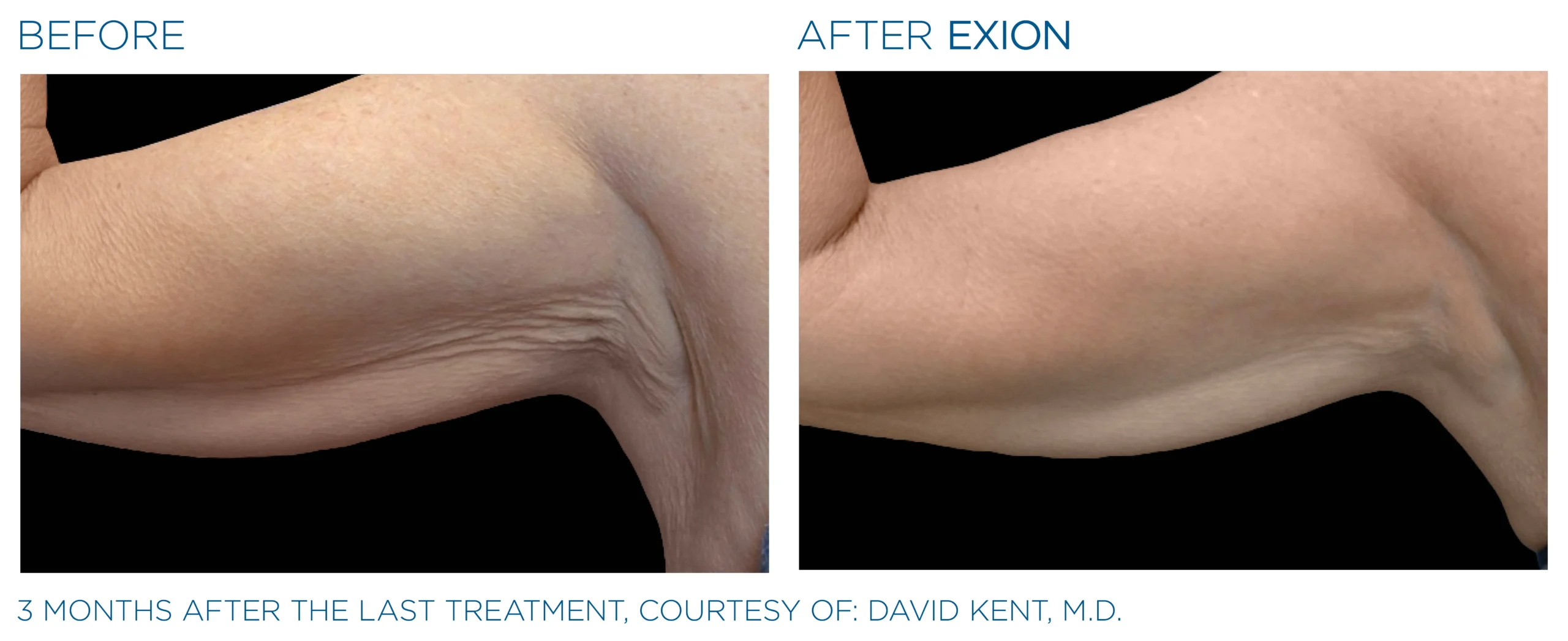 Exion Before & After 7