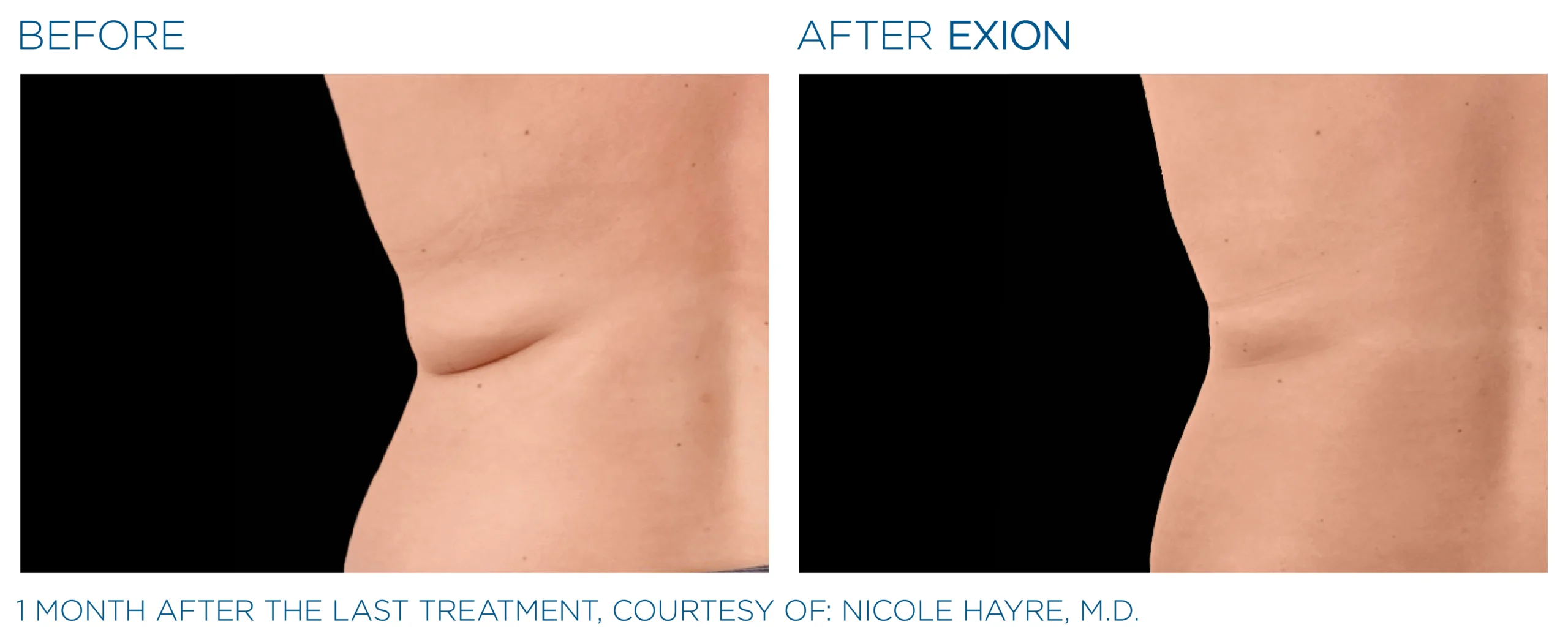 Exion Before & After 8