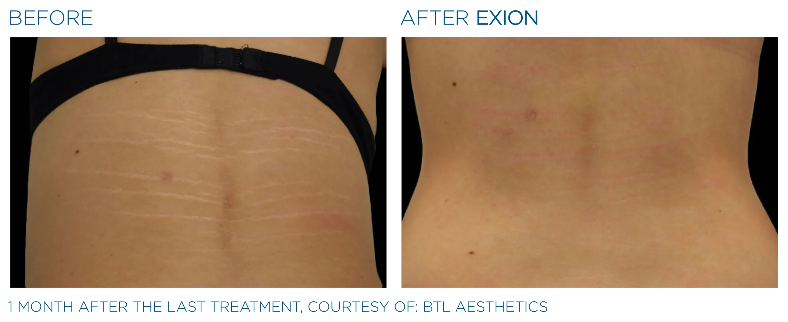 Exion Before & After 9
