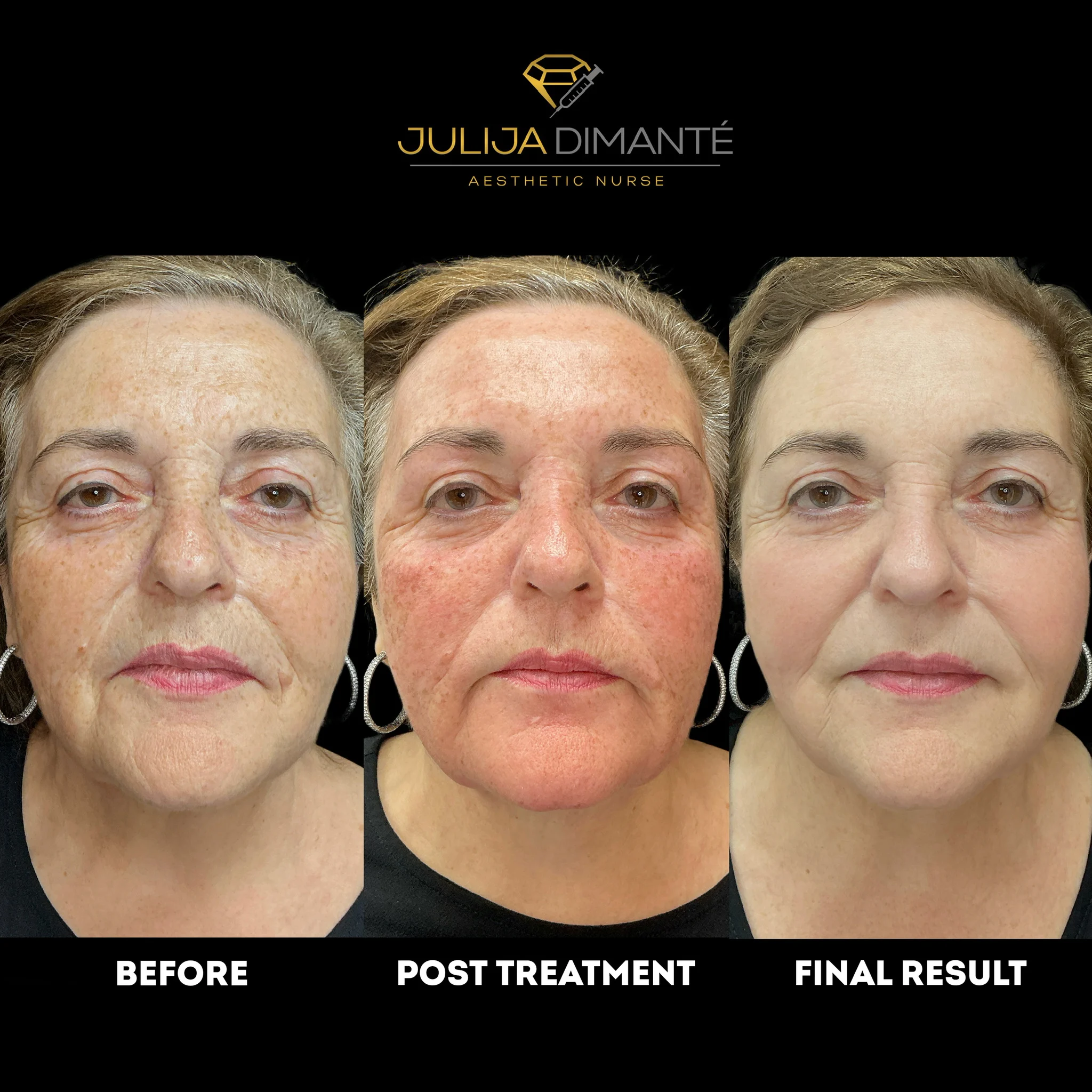 Before & After Candela Nordlys™ (2)