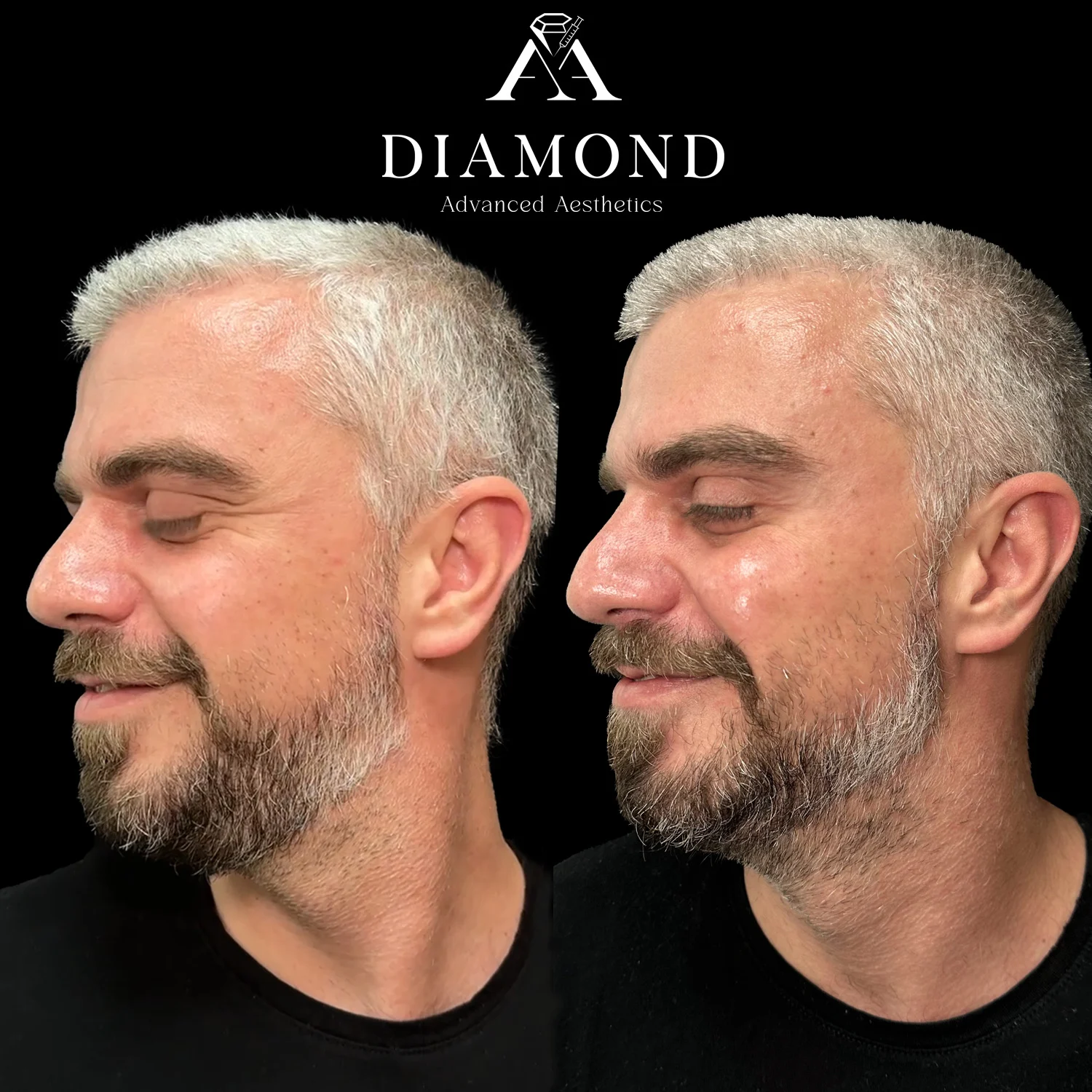 Before & After Candela Nordlys™ (3)