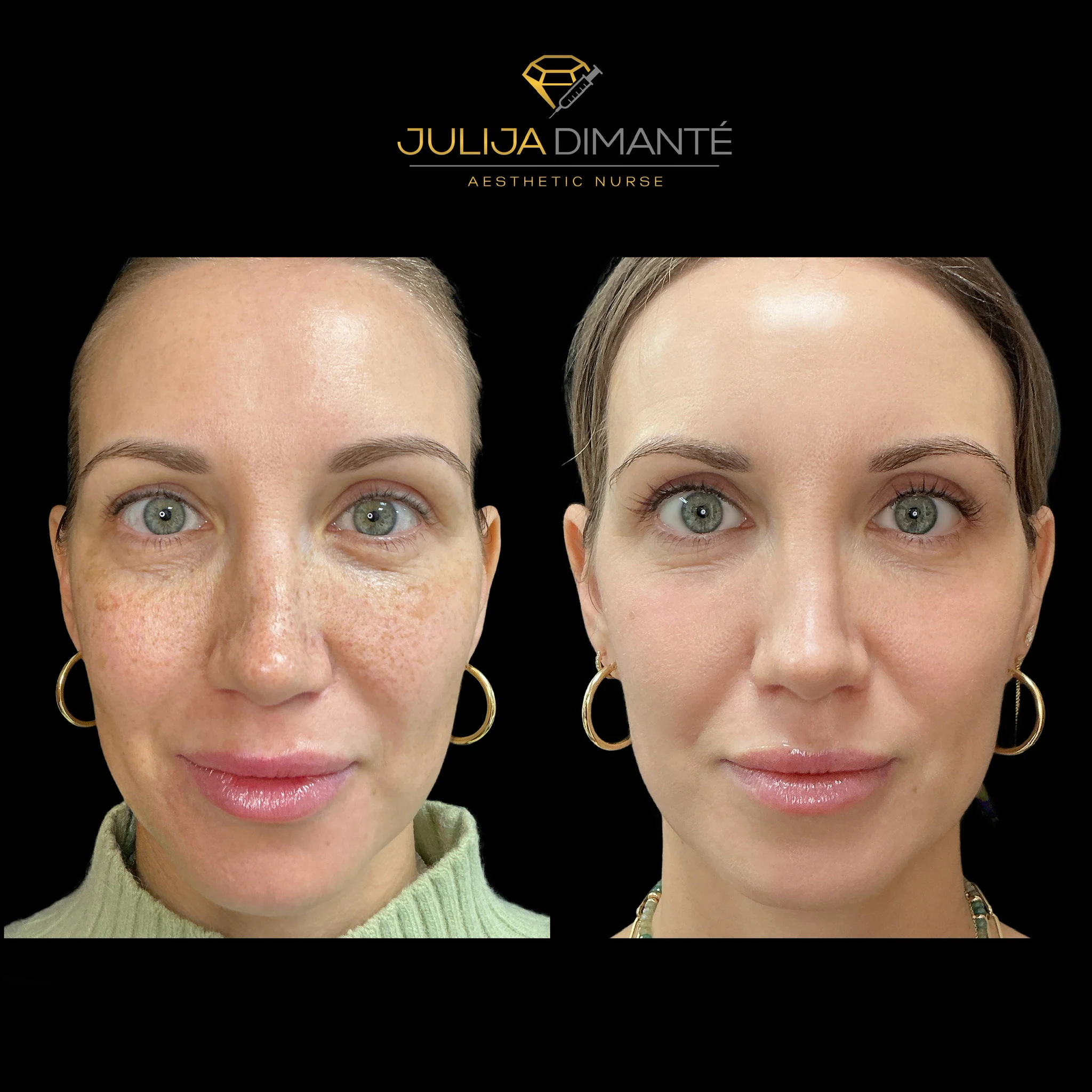 Before & After Candela Nordlys™ (4)