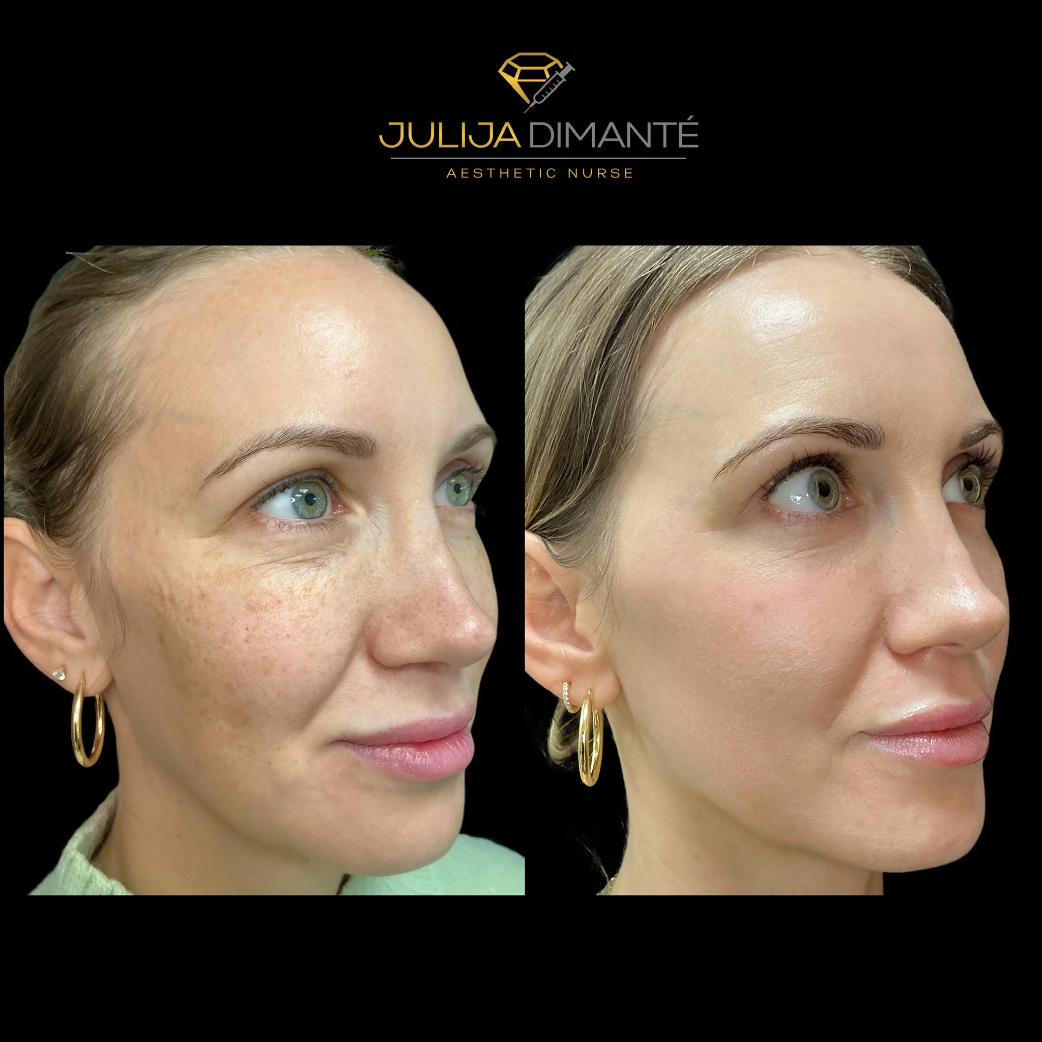 Before & After Candela Nordlys™