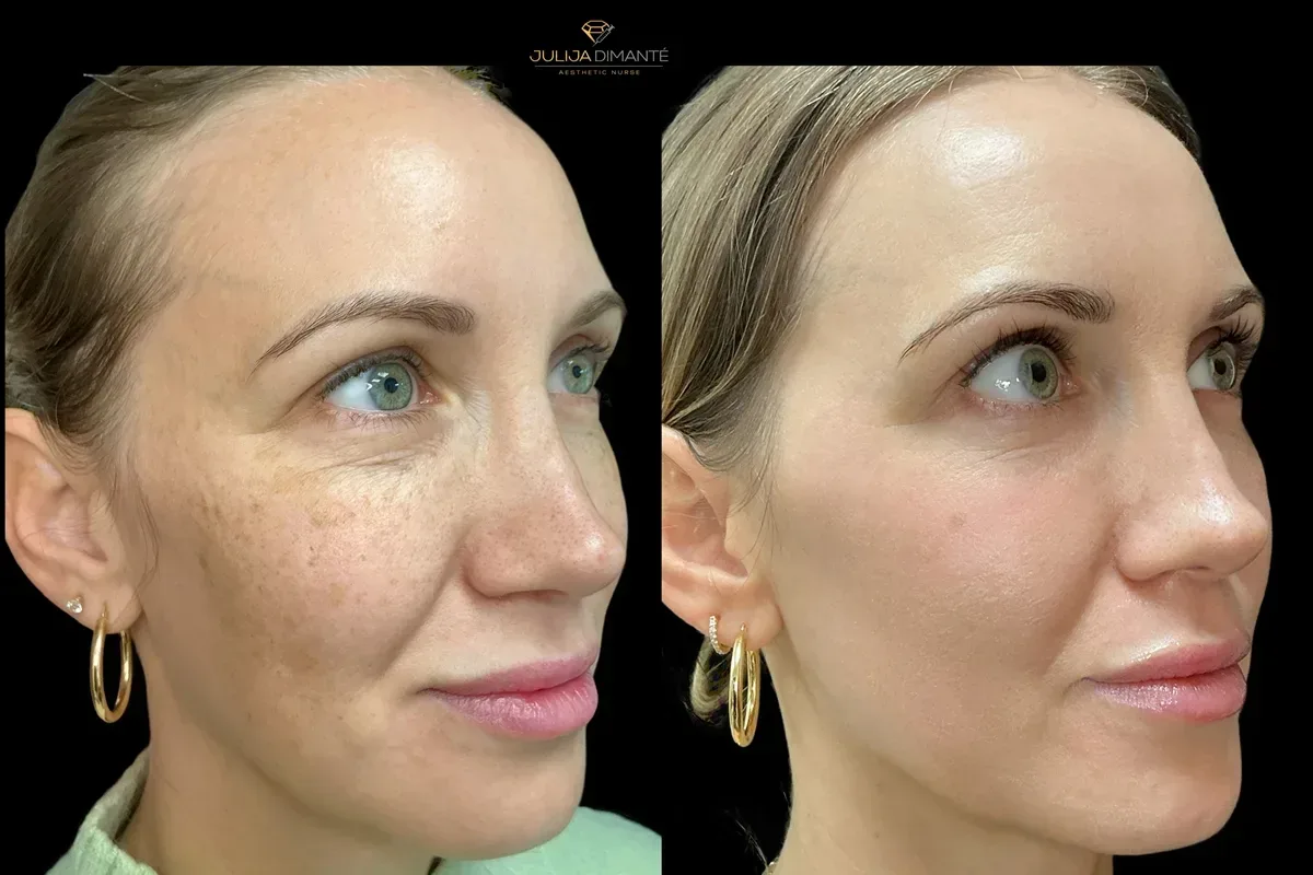 Light and Bright treatment before and after showing smoother, brighter-looking skin with Nordlys IPL + Frax 1550