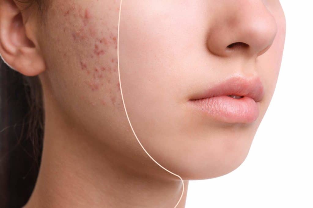 Best Cosmetic Treatments That Actually Get Rid Of Acne