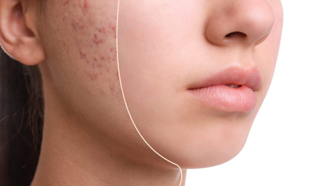 Best Cosmetic Treatments That Actually Get Rid Of Acne